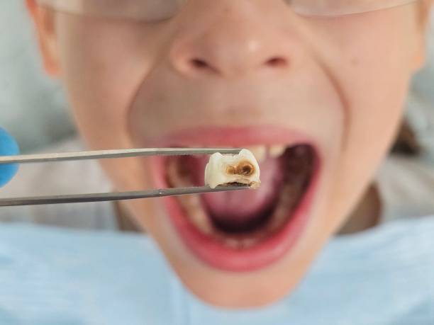 Best Emergency Root Canal Therapy in Britt, IA
